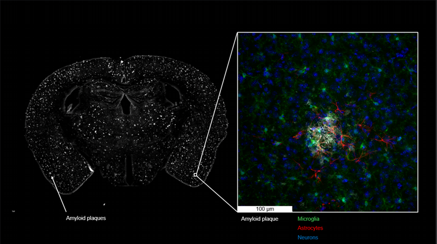 A lightsheet microscope image of a brain taken from a mouse model of Alzheimer's disease (left) showing amyloid plaques in white. Right - a closeup of glial cells interacting with an amyloid plaque (Image supplied)